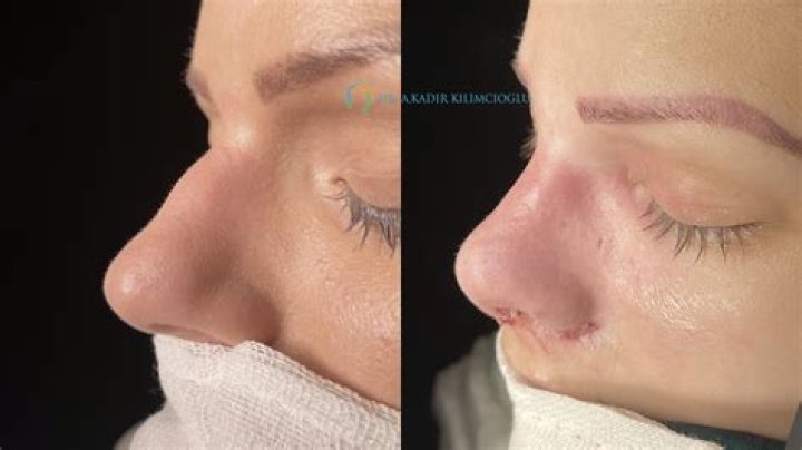 Rhinoplasty in Chattanooga: Find the Best Surgeons Now!