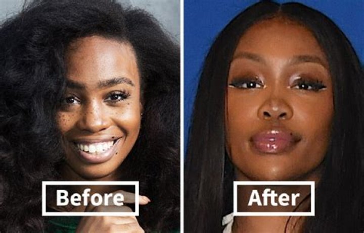 "Sza Before And After Plastic Surgery Everything"
